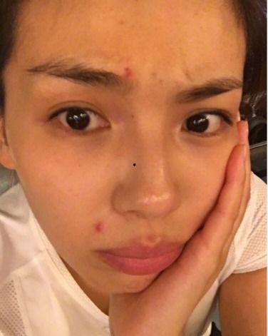 爆痘明星,揭秘护肤与压力的微妙关系